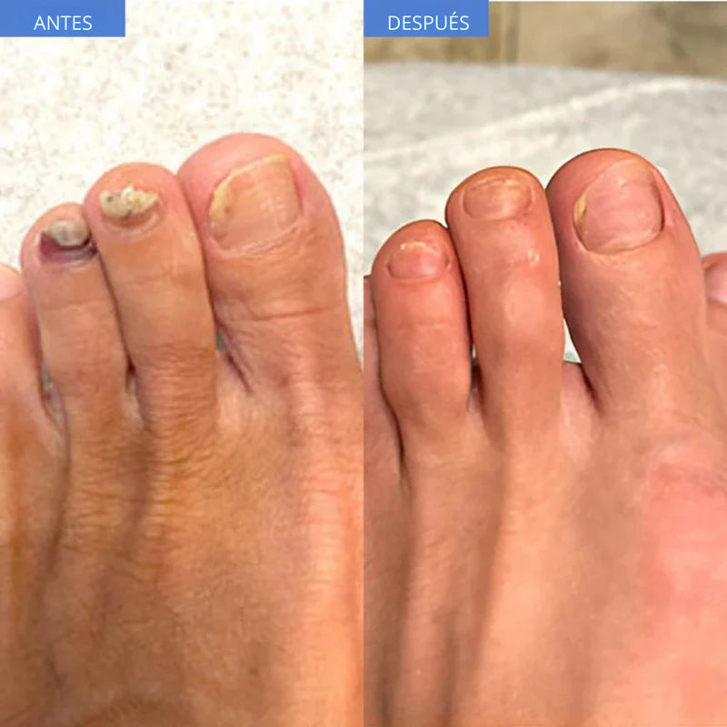 UñaFungusOff™- Parches que eliminan hongos y restauran uñas dañadas