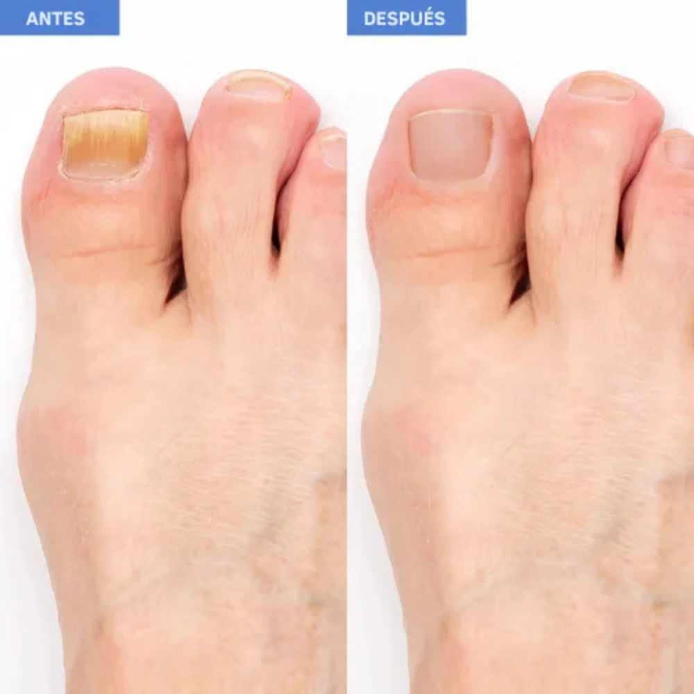 UñaFungusOff™- Parches que eliminan hongos y restauran uñas dañadas